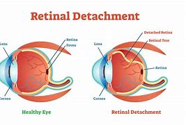 Image result for Retinal Detachment Laser Surgery