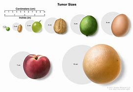 Image result for Tumor Sizes in Centimeters