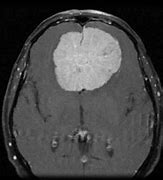 Image result for Meningioma Brain Tumor MRI