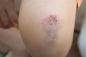 Image result for Child Bruises