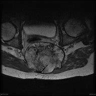 Image result for Sacral Chordoma Tumor