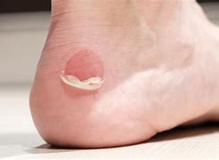 Image result for Blister On Back of Foot