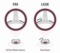 Image result for PRK vs Lasik