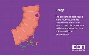 Image result for Small Bowel Tumors