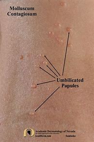 Image result for Inflamed Molluscum Contagiosum