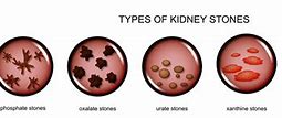 Image result for What Do Kidney Stones Look Like