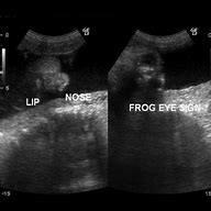 Image result for Anencephaly USG