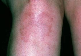 Image result for Round Red Rash On Leg