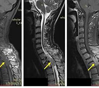 Image result for Schwannoma Tumor Neck