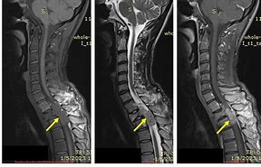 Image result for Schwannoma Tumor On Spine Surgery