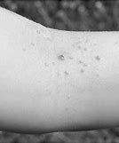 Image result for Molluscum Contagiosum Virus Pox