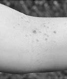 Image result for Molluscum Scars Treatment