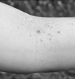 Image result for Molluscum Contagiosum and Chicekn Pox