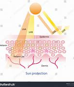 Image result for UVA Sun Burn