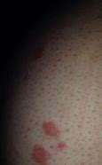 Image result for Red Rash Spots On Skin