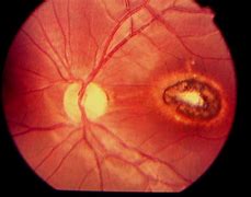 Image result for What Is a Mole On the Retina