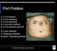Image result for Laparoscopic Gastric Bypass