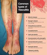 Image result for Leukocytoclastic Vasculitis Palpable Purpura