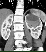 Image result for 9 Cm Complex Cyst On Kidney