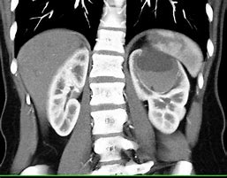 Image result for complex cysts on renal signs