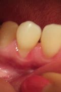 Image result for Invisalign Gum Recession