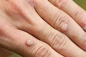 Image result for Dying Common Wart