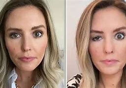 Image result for After Botched Plastic Surgery