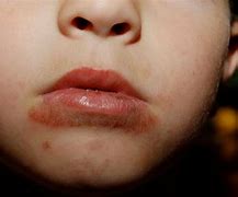 Image result for Food Allergy Rash around Mouth