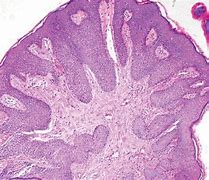 Image result for Condyloma Acuminatum Pathology