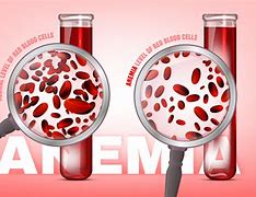 Image result for anemia