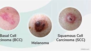 Image result for Types of Skin Cancer Names