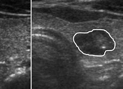 Image result for Thyroid Nodule with Calcification