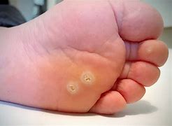 Image result for Wart On Toe Removal