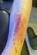 Image result for What Does an Infected Burn Look Like