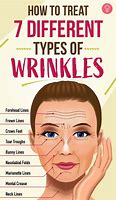 Image result for Types of Facial Wrinkles