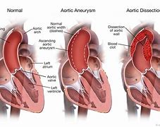 Image result for Aortic Aneurysm Dissection