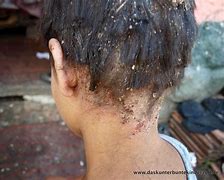 Image result for Untreated Lice Infestation