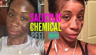 Image result for Salicylic Acid On Black Skin