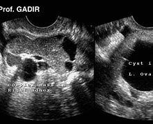 Image result for 6 Cm Cyst On Ovary