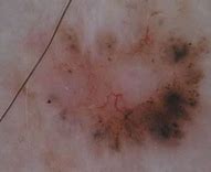 Image result for Pigmented Basal Cell Carcinoma Dermoscopy