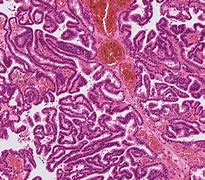 Image result for Choroid Plexus Papilloma Carcinoma