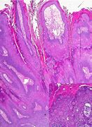 Image result for Canine Papilloma On Skin