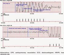 Image result for Recover CPR Pulseless VT