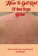 Image result for How Do You Get Rid of Bed Bug Bites