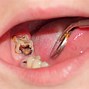 Image result for Back Tooth Decay