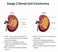 Image result for Kidney Cancer Staging