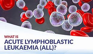 Image result for Acute Lymphoblastic Leukemia Symptoms