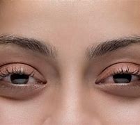 Image result for Eyes After Smoking Marijuana