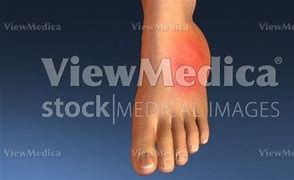 Image result for Jones Fracture Swelling