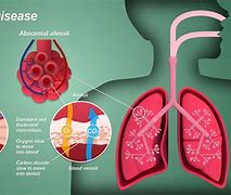Image result for Lung Tumor Size Prognosis